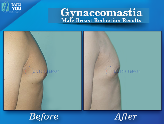 Gynaecomastia before after image